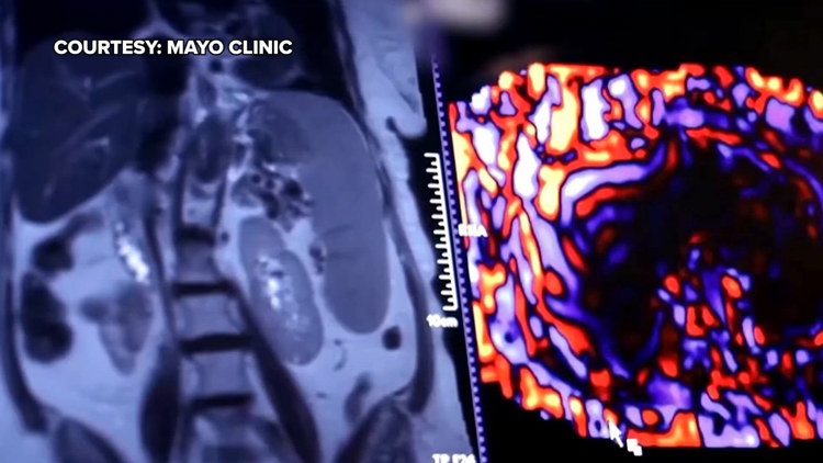 Healthy SA: Battling liver cancer, a disease which often has no symptoms early on — KENS 5 (San Antonio), Stanley Health news